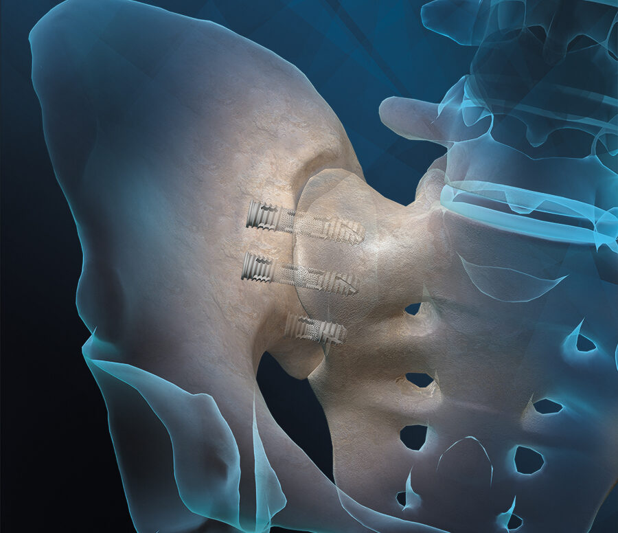hip repair