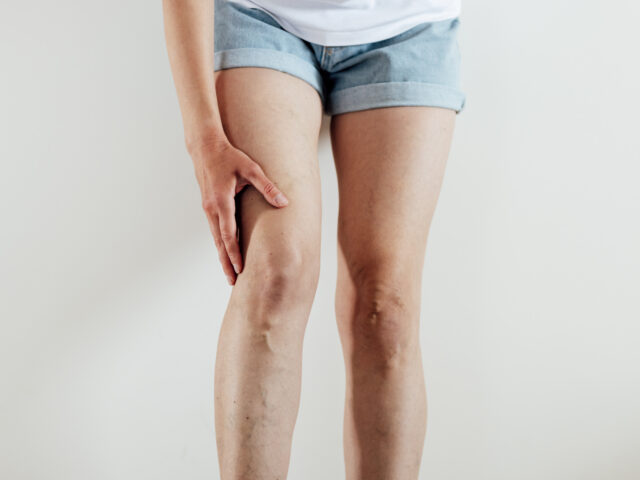 Woman with tired painful leg