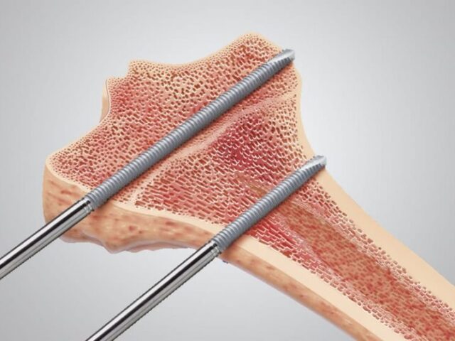 Bone Screws