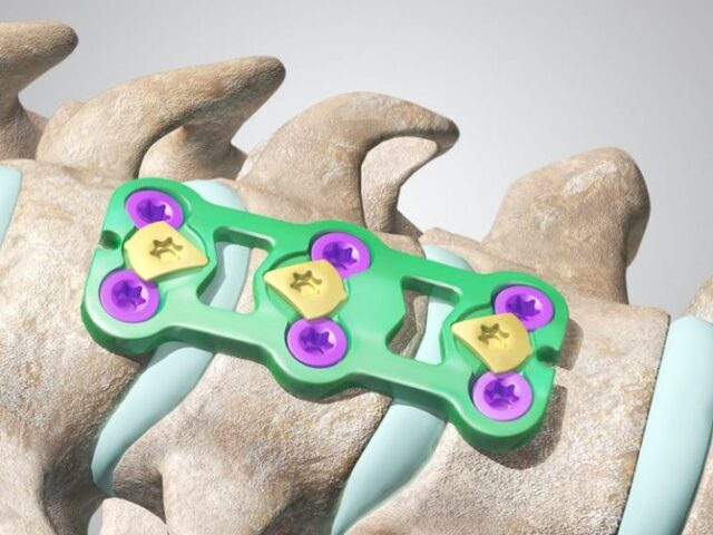 Anterior Cervical Fixation