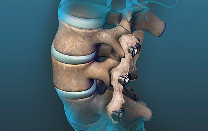 spine repair
