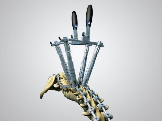 Posterior Thoracolumbar Fixation