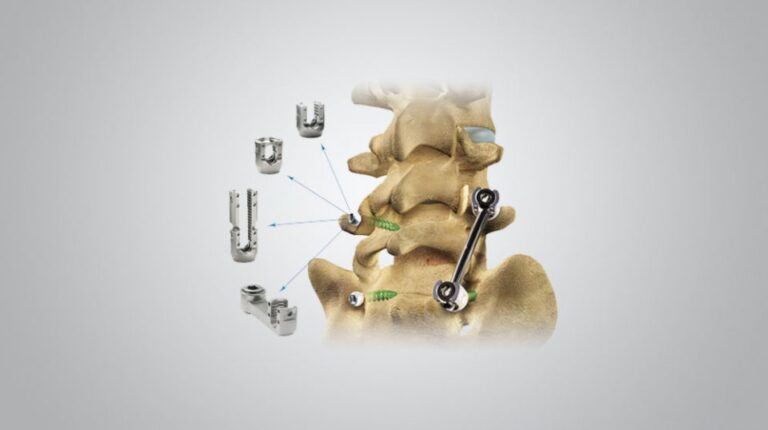 Firebird Spinal Fixation System - Orthofix
