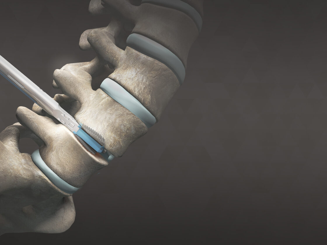 Spinal Medical Devices Orthofix