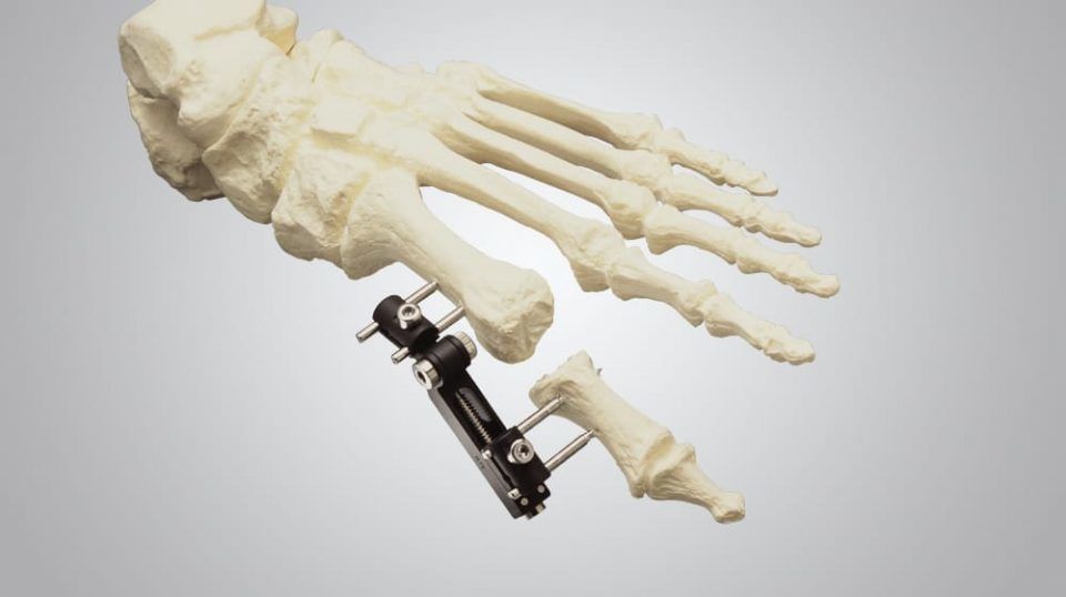 MiniRail System Orthofix