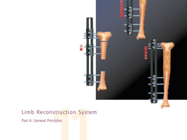limb reconstruction system general principles