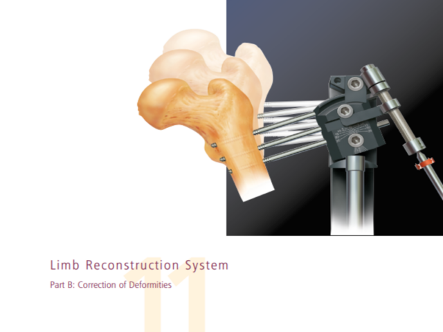 limb reconstruction system correction of deformities