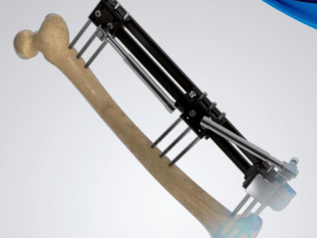 limb reconstruction system