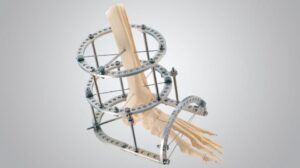 TrueLok Ring Fixation System - Orthofix