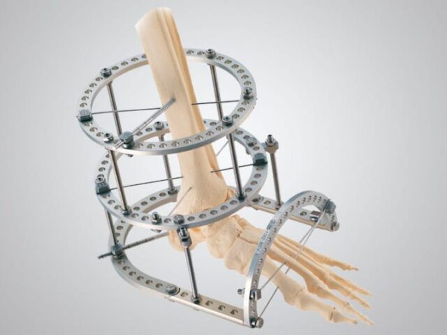 TrueLok Ring Fixation System