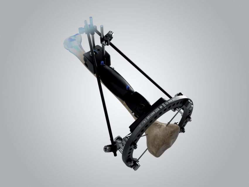 XCaliber Hybrid Fixation Orthofix