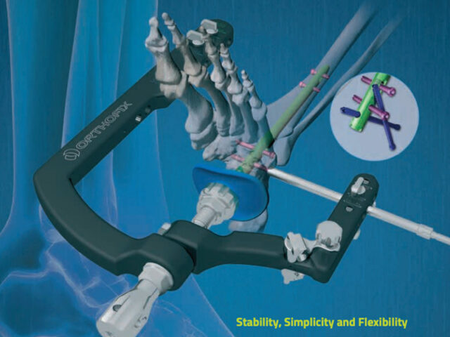 Ankle Hindfoot Nailing (AHN) System brochure