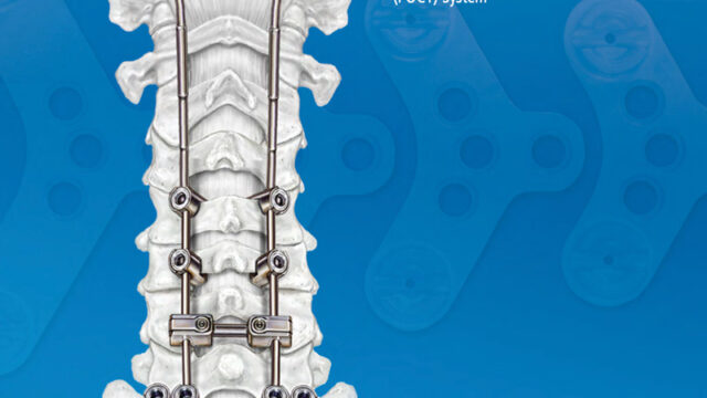Ascent Posterior Occipital Cervico-Thoracic System illustration