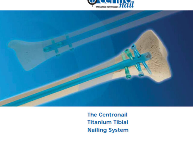 Centronail Titanium Tibial Nail