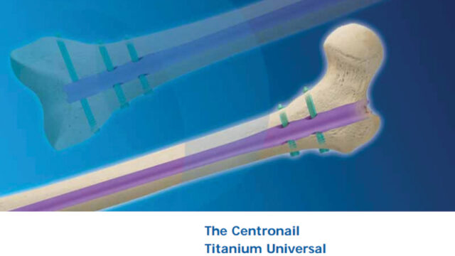 Centronail Titanium Femoral Nail