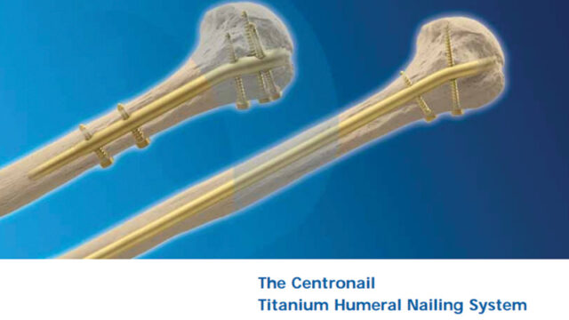 Centronail Titanium Humeral Nail system
