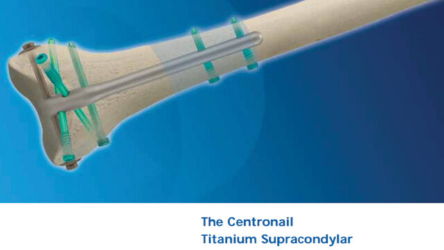 Centronail Titanium Supracondylar and Retrograde Nail