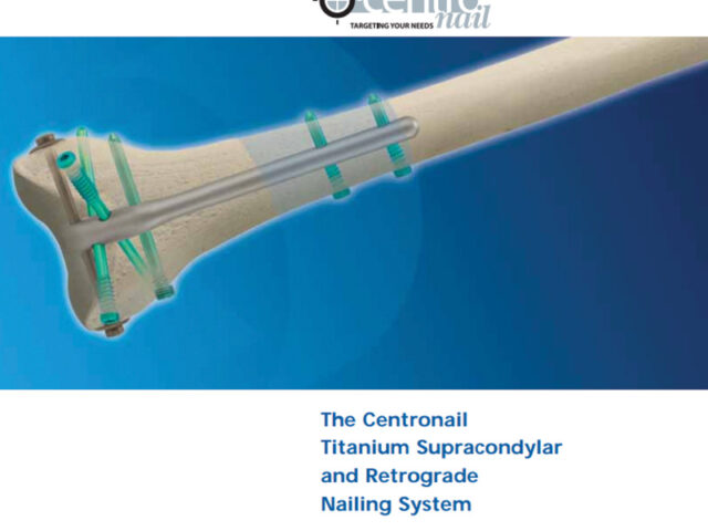 Centronail Titanium Supracondylar and Retrograde Nail