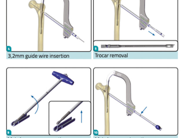 Chimaera Hip Fracture System instructions