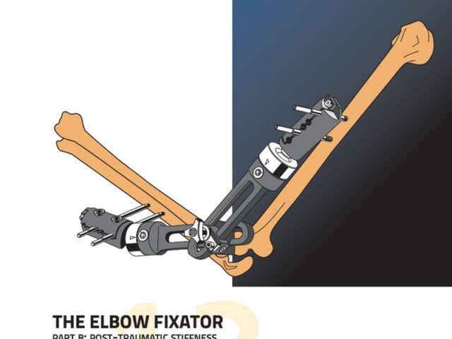 The elbow fixator in post-traumatic stiffness illustration