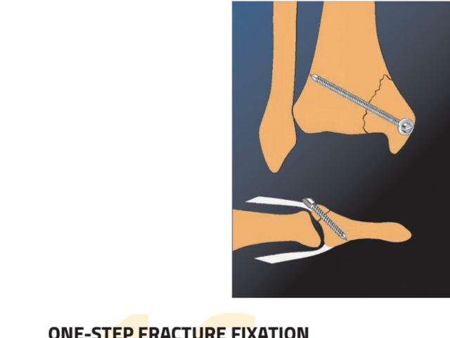 Fragment Fixation System one step
