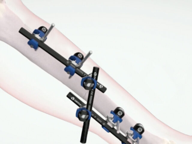 Galaxy Fixation Shoulder System elbow rendering