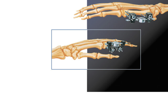 treatment of fractures and deformities in small bones