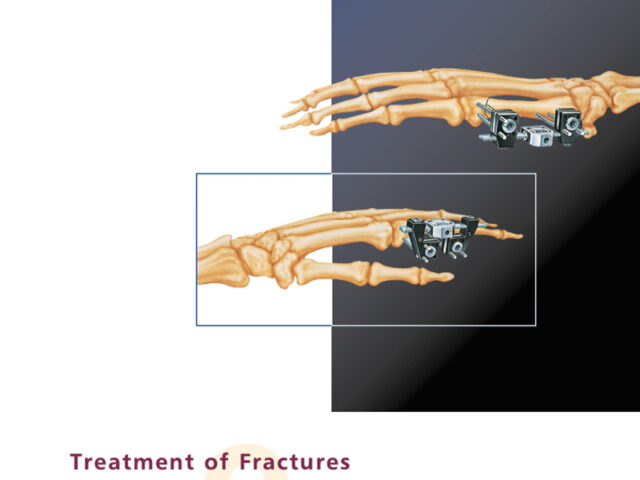 treatment of fractures and deformities in small bones