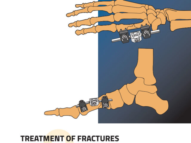 treatment of fractures and deformities in small bones reference guide