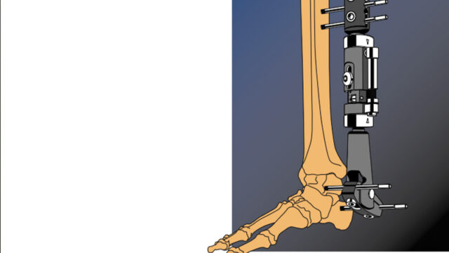 Distal tribal and pilon fractures with radiolucent ankle clamp