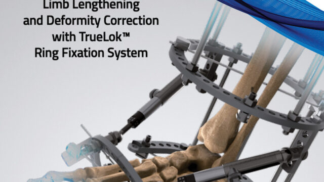 TrueLok Ring Fixation System general principles