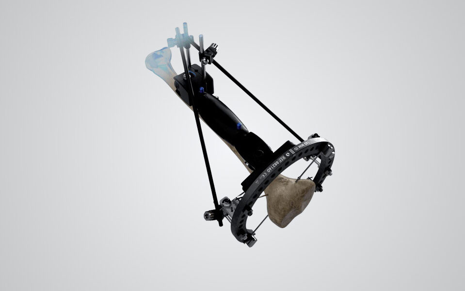 XCaliber Hybrid Fixation