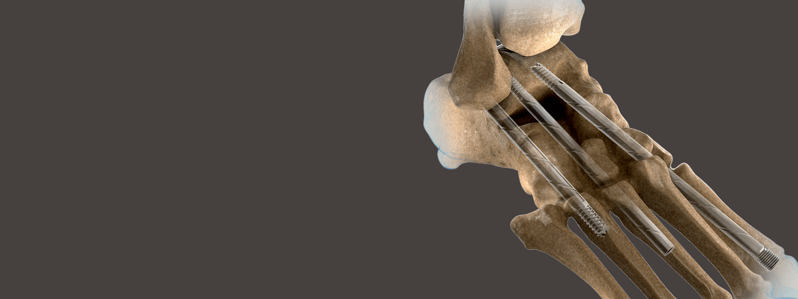 3D rendering of screws inside of a foot's bone structure