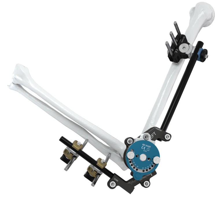 Galaxy Fixation Elbow Configuration