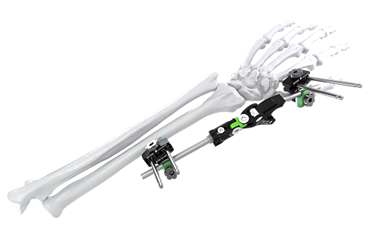 Galaxy Fixation Wrist Configuration