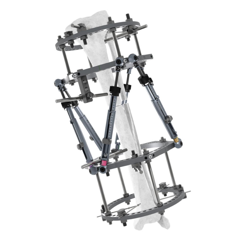 TL-HEX using the TrueLok platform on a bone